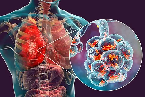 Pneumonia Treatment