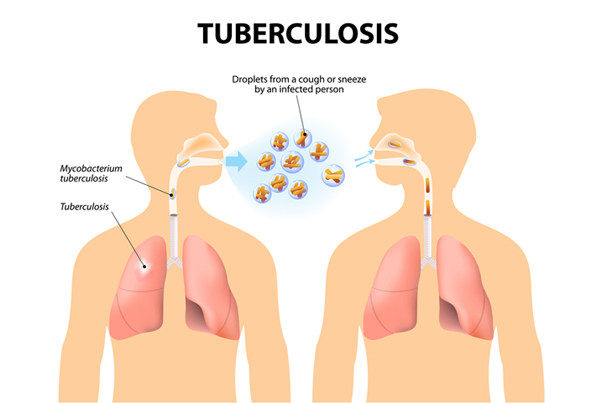Diagnosis and Management of Tuberculosis