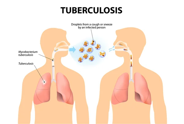 Diagnosis and Management of Tuberculosis
