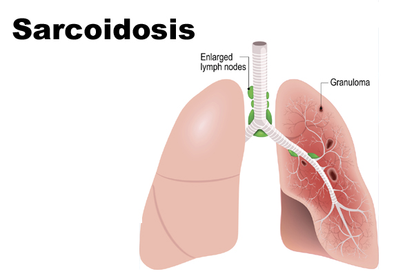 Treatment of Sarcoidosis