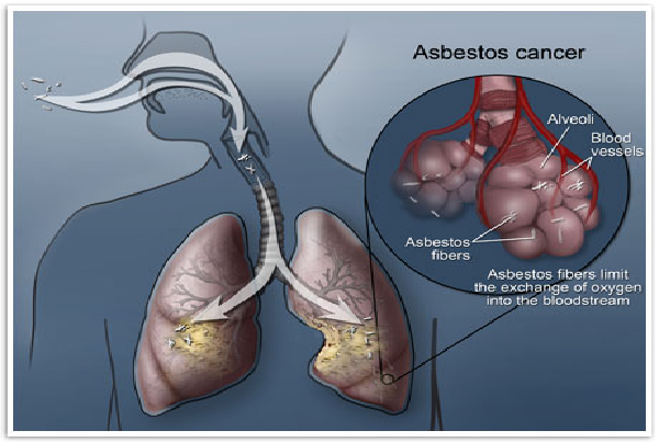 Treatment of Asbestosis