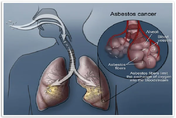 Treatment of Asbestosis