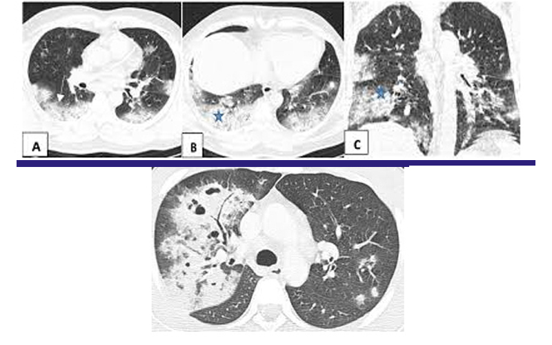 Lower/Upper Respiratory Tract Infection