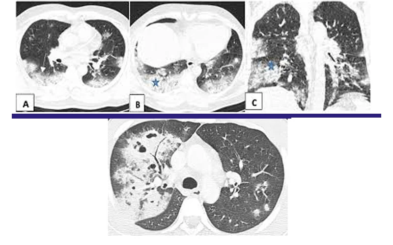 Lower,Upper Respiratory Tract Infection